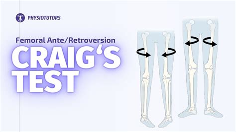 craigs test for torsion angle|craig's test femoral anteversion.